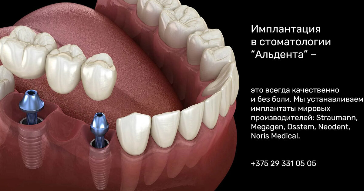 Имплантациязубов
