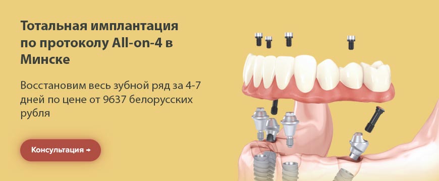 Имплантация All-on-4 в Минске, цены, консультация
