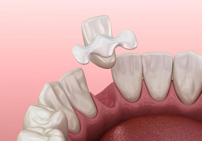 адгезивное протезирование