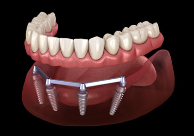 тотальное протезирование