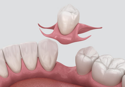 пртез бабочка