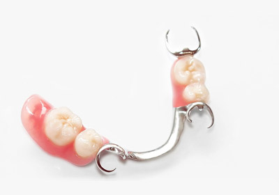 бюгельный протез