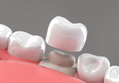 протезирование коронками