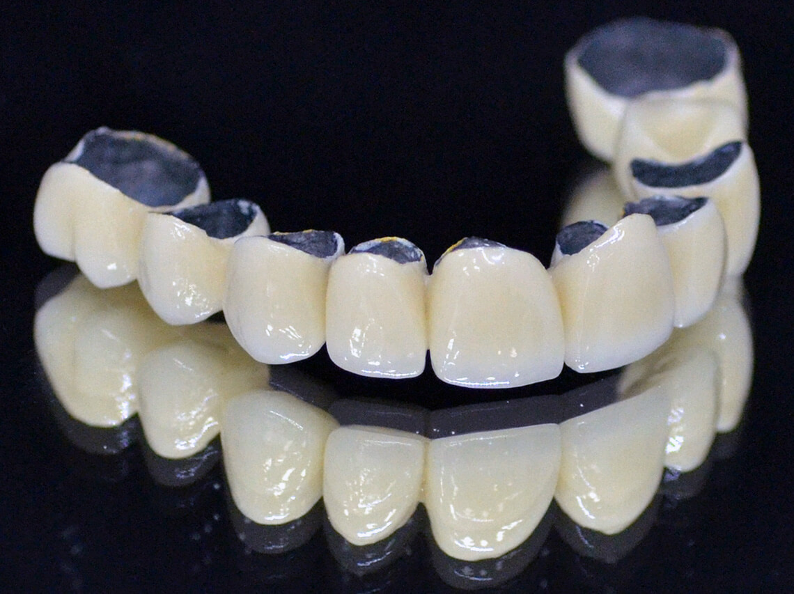 Металлокерамические коронки