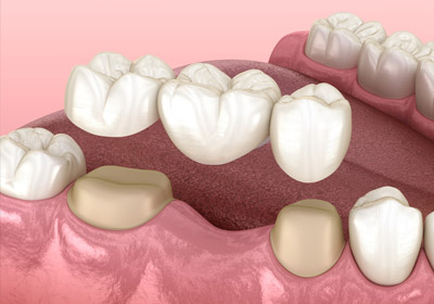 мостовидный протез
