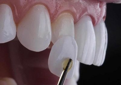 виниры на зубы