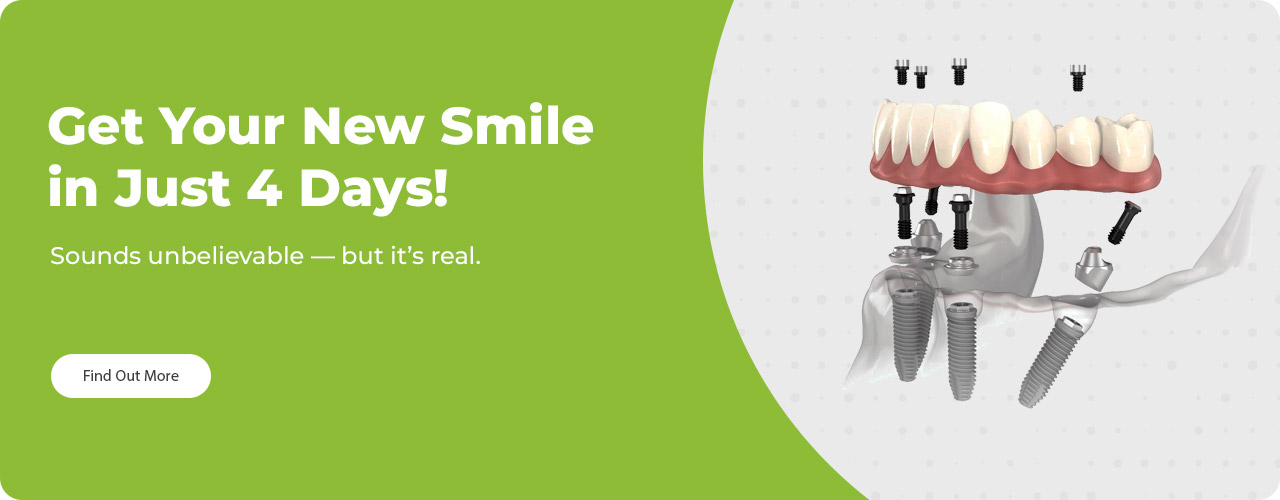 Имплантация all-on-4 в Минске