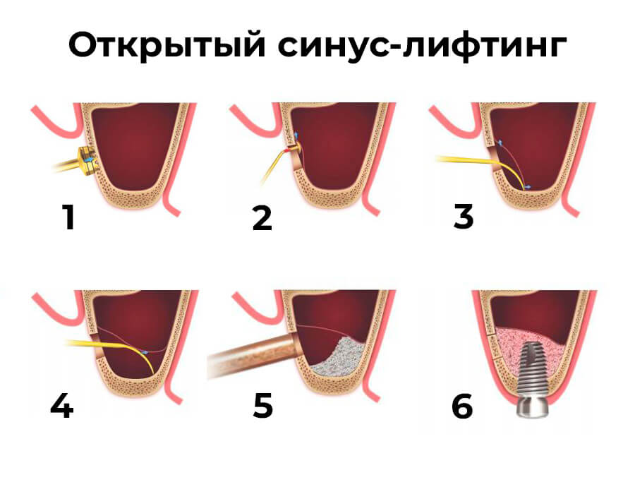 Открытый синус-лифтинг