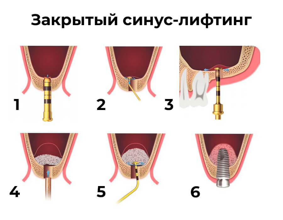 Закрытый синус-лифтинг